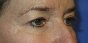 Eyelid Lift Case 5551 Before Photo Eyelid Lift