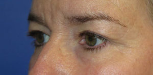 Eyelid Lift Case 5551 Before Photo Eyelid Lift
