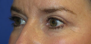 Eyelid Lift Case 5551 After Photo Eyelid Lift