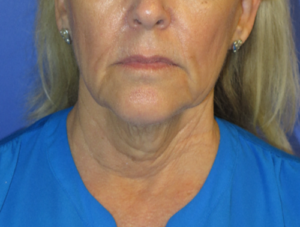 FACEology Lift / Neck Lift