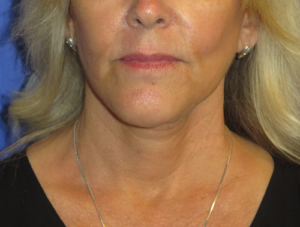 FACEology Lift / Neck Lift