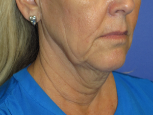 FACEology Lift / Neck Lift