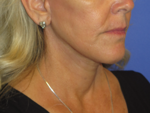 FACEology Lift / Neck Lift