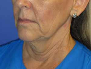 FACEology Lift / Neck Lift