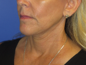 FACEology Lift / Neck Lift