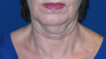 FACEology Lift / Neck Lift