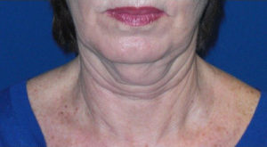 FACEology Lift / Neck Lift Case 5783 Before Photo FACEology Lift / Neck Lift