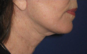 FACEology Lift / Neck Lift