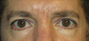 Eyelid Lift Case 5538 Before Photo Eyelid Lift