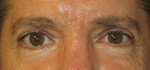 Eyelid Lift Case 5538 After Photo Eyelid Lift