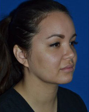 Chin Liposuction Case 5433 After Photo Chin Liposuction