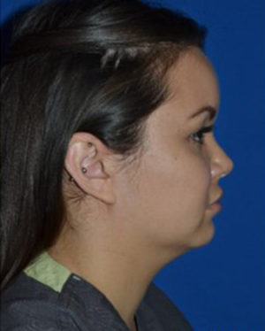 Chin Liposuction Case 5433 Before Photo Chin Liposuction