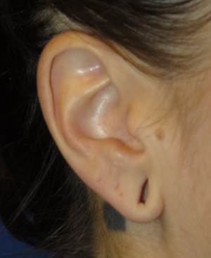 Ear Surgery Case 5384 Before Photo Ear Surgery