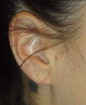 Ear Surgery Case 5384 After Photo Ear Surgery