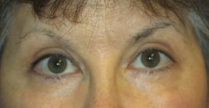 Eyelid Lift Case 5558 After Photo Eyelid Lift