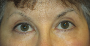 Eyelid Lift