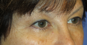 Eyelid Lift Case 5558 Before Photo Eyelid Lift