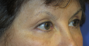 Eyelid Lift Case 5558 After Photo Eyelid Lift