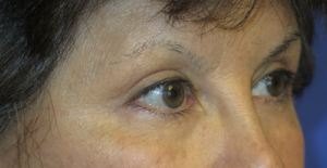 Eyelid Lift