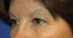 Eyelid Lift Case 5558 Before Photo Eyelid Lift