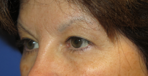 Eyelid Lift