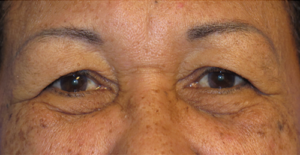 Eyelid Lift