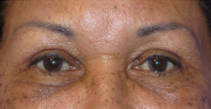 Eyelid Lift