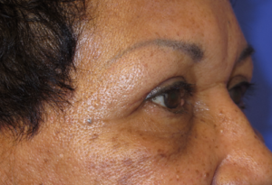 Eyelid Lift