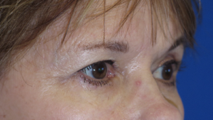 Eyelid Lift Case 5505 Before Photo Eyelid Lift