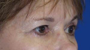 Eyelid Lift