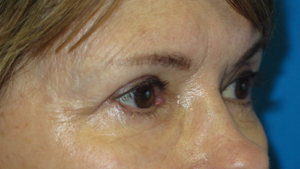 Eyelid Lift Case 5505 After Photo Eyelid Lift