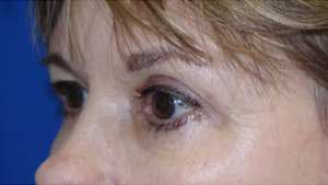 Eyelid Lift Case 5505 Before Photo Eyelid Lift