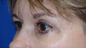 Eyelid Lift