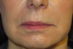 Laser Resurfacing