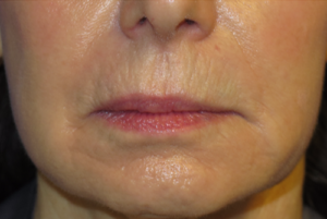 Laser Resurfacing