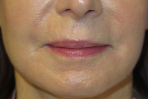 Laser Resurfacing