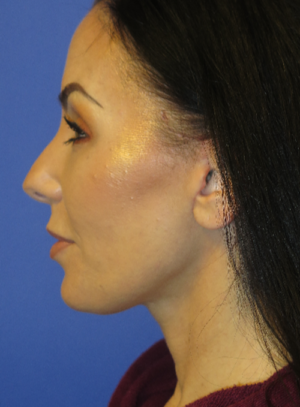 FACEology Lift / Neck Lift Case 5763 After Photo FACEology Lift / Neck Lift