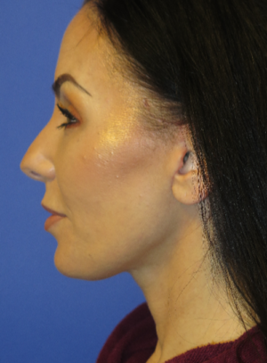 FACEology Lift / Neck Lift