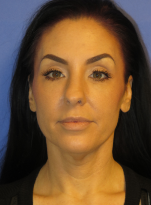 FACEology Lift / Neck Lift Case 5763 Before Photo FACEology Lift / Neck Lift