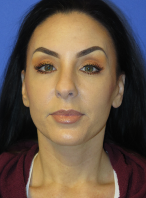 FACEology Lift / Neck Lift Case 5763 After Photo FACEology Lift / Neck Lift