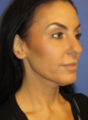FACEology Lift / Neck Lift Case 5763 Before Photo FACEology Lift / Neck Lift