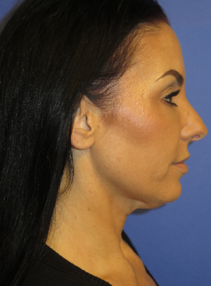 FACEology Lift / Neck Lift Case 5763 Before Photo FACEology Lift / Neck Lift