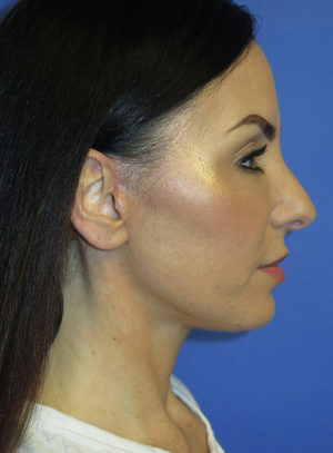 FACEology Lift / Neck Lift Case 5763 After Photo FACEology Lift / Neck Lift
