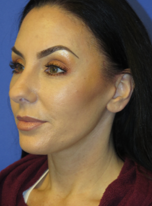 FACEology Lift / Neck Lift Case 5763 After Photo FACEology Lift / Neck Lift