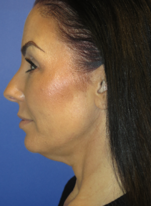 FACEology Lift / Neck Lift Case 5763 Before Photo FACEology Lift / Neck Lift