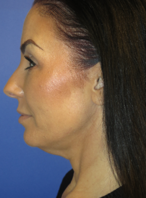 FACEology Lift / Neck Lift