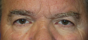 Eyelid Lift Case 5498 Before Photo Eyelid Lift