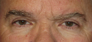Eyelid Lift Case 5498 After Photo Eyelid Lift
