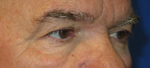 Eyelid Lift Case 5498 Before Photo Eyelid Lift