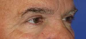 Eyelid Lift Case 5498 After Photo Eyelid Lift